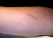 Very-minor-scar