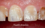 Erosion-dental.jpg