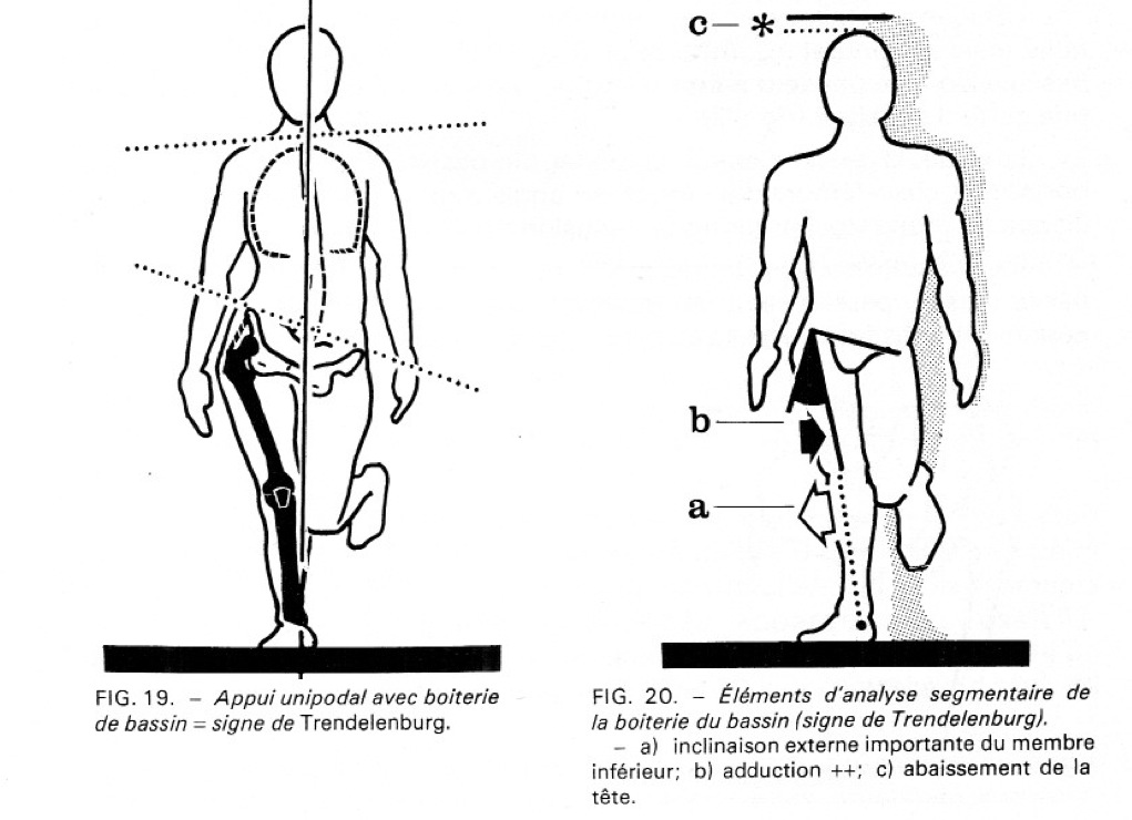 image gallery: trendelenburg