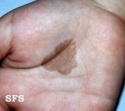 Tinea.jpg