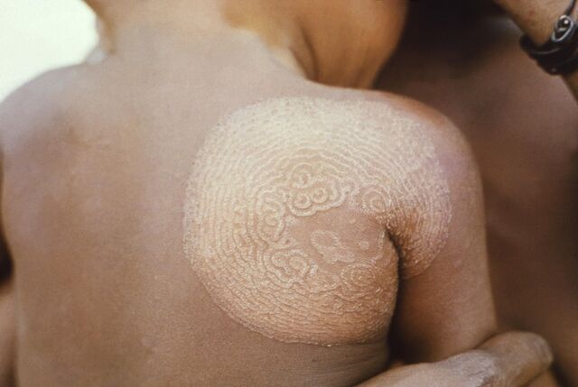 Arquivo:Tinea imbricata.jpg