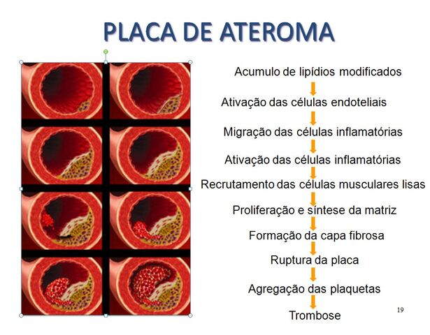 Arquivo:Ateroma.jpg