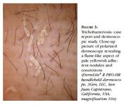 Tricobacteriiose.jpg