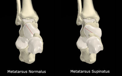Metatarsus Supinatus vs No Met Supinatus