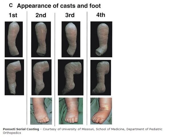 File:Ponseti Casting Technique.jpg