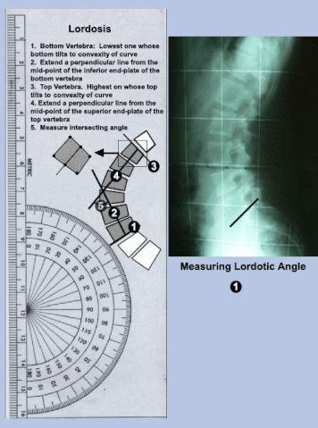 File:Measuringthelordosis.gif