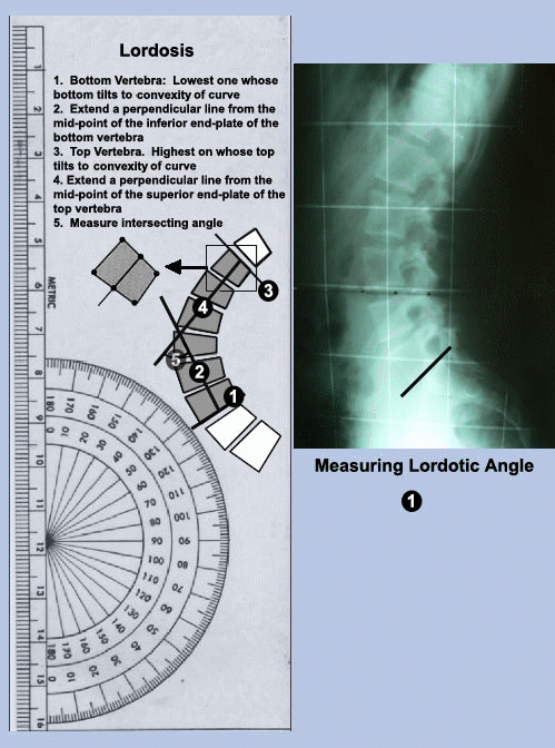 Measuringthelordosis