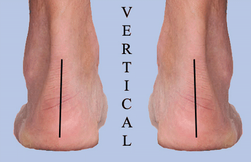 Abnormal Foot Pronation
