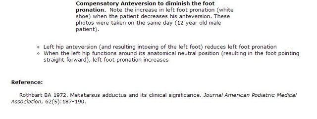 File:Compensatory Anteversion to decrease intoeing.jpg