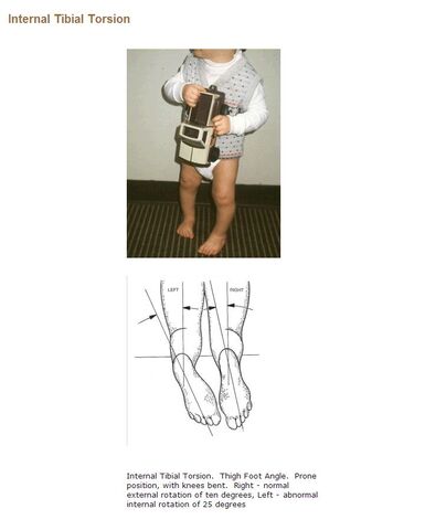 File:Internal Tibial Torsion.jpg