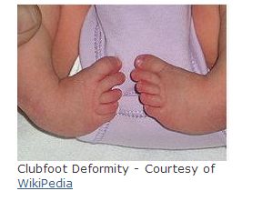 Clubfoot Deformity