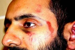 Saudi Prince Injured