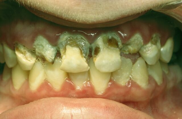 File:Tooth-decay-4-1-.jpg