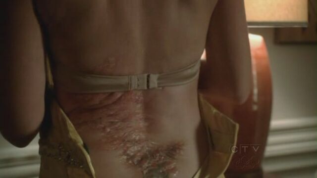 File:Angie scar.jpg