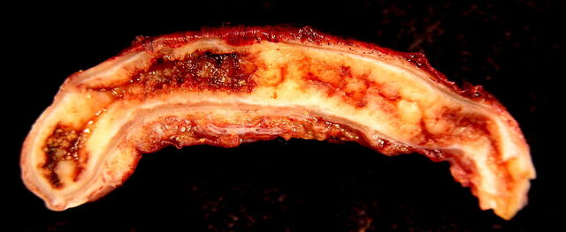 File:1024px-Acute Appendicitis.jpg