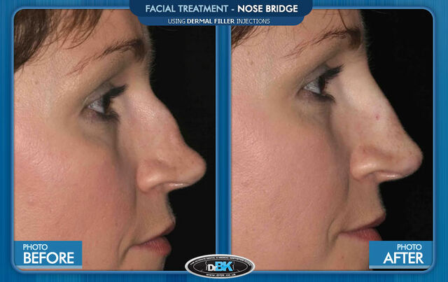 File:ResultsNoseBridge.jpg