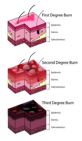 File:Burn Degree Diagram svg.png
