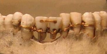 Dent