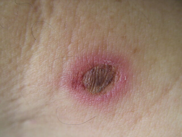 File:Second degree burn (heat).jpg