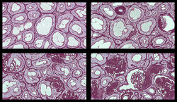 Cyberbrain Sclerosis