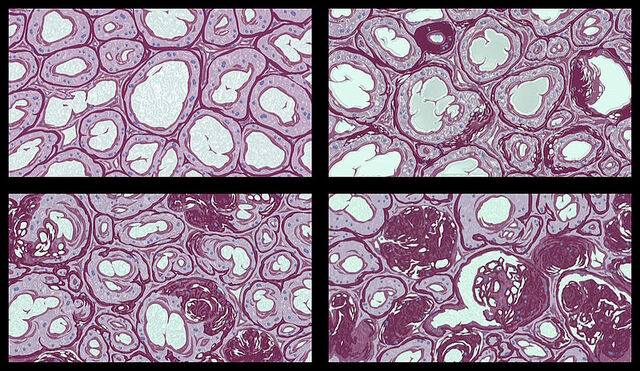 File:Cyberbrain Sclerosis.jpg