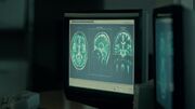 Encephalitis