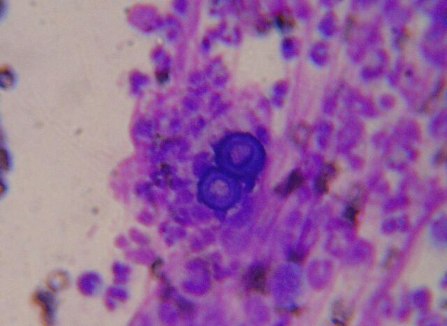 File:Blastomycosis cropped.jpg