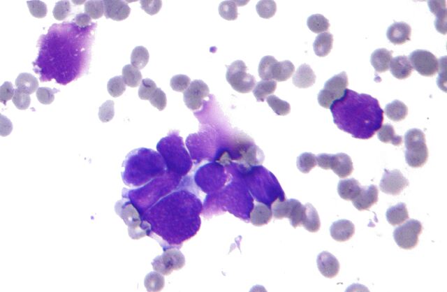 File:Small cell lung cancer - cytology.jpg