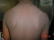 Familial acanthosis nigricans2