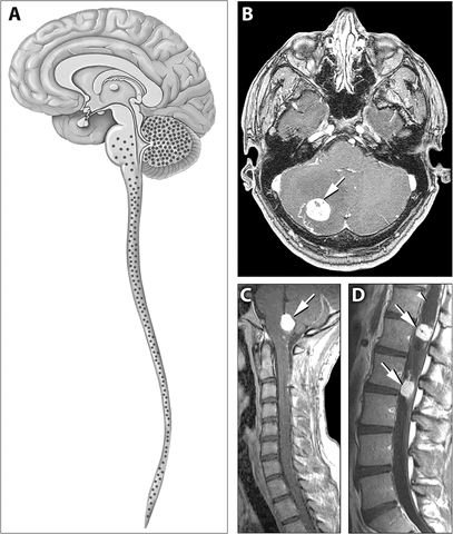 File:Hippel Lindau.gif