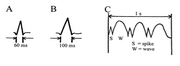 Epilepsi1