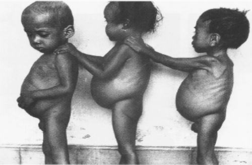 Kwashiorkor.fig2.jpg
