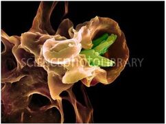 Tuberculose2.jpg