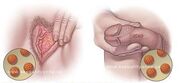 Figura4HPV.jpg