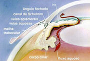 Glaucoma4