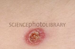 Tuberculose8.jpg