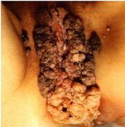 Figura2HPV.jpg