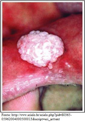 Arquivo:Figura3 HPV.jpg