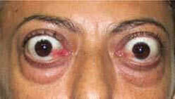 Hipertireoid2