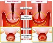 Figura5HPV.jpg