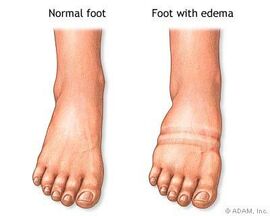 Edema01