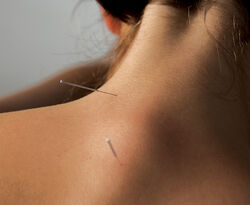 Healthy-acupuncture
