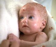 Linnis infant