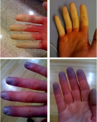 Raynaud's syndrome.jpg