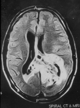 Papillary glioneuronal tumor