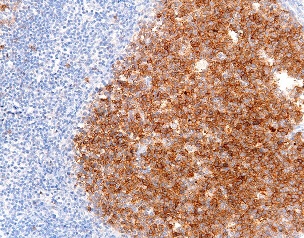 File:CD10.germinal center.200x.jpg
