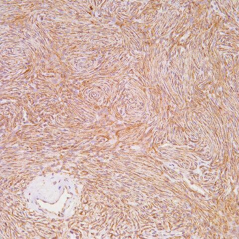 File:Claudin-1.perineurioma.200x.1.jpg