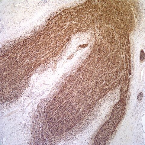 File:S100.desmoplastic neurotropic melanoma.5.jpg