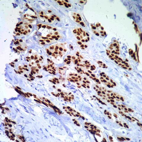 File:PR.tumor.400x.jpg