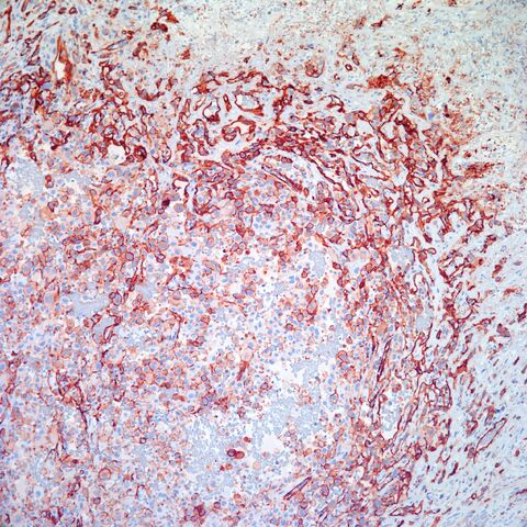 File:CD31.epithelioid angiosarcoma.3.jpg